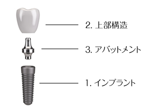 インプラントは3つの部品で構成されています