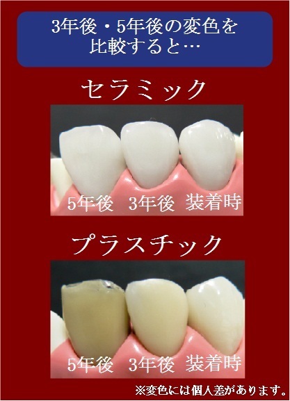 セラミックと保険の違い