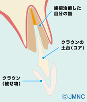被せの構造