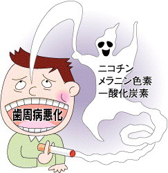 たばこ、歯周病悪化