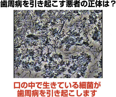 歯周病菌