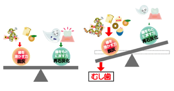 虫歯原理