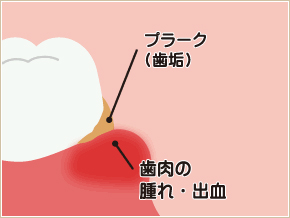 歯肉炎