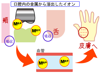 金属アレルギー