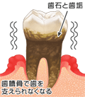 歯周病